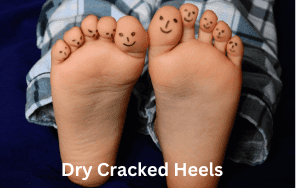 Dry Cracked Heels