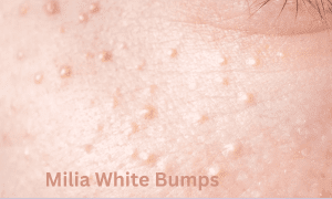 Milia White Bumps