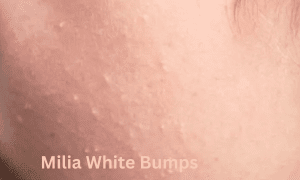 Milia White Bumps