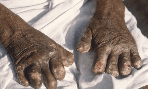 Leprosy Cases In The US